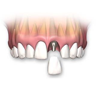 Single Tooth Dental Implants Hoover, AL